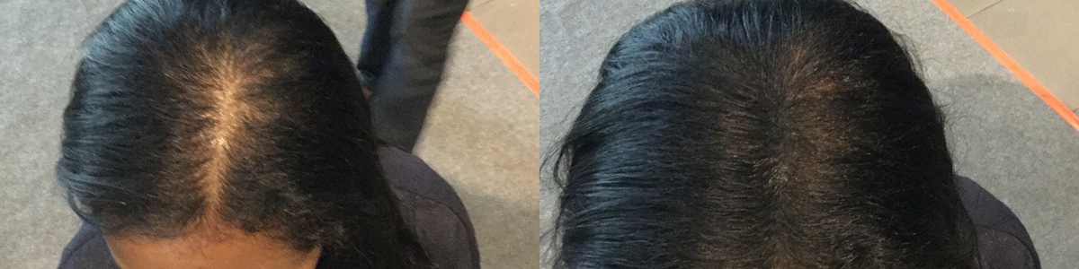 hair regrowth instantly with toppik